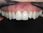 Figure 7 Clinical photograph of
maxillary left central incisor implant replacement. CAD/CAM zirconium abutment and zirconium ceramic crown restoration demonstrate ideal esthetics in the smooth/scalloped
gingival biotype patient.