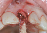 Figure 3 A flapless extraction of a hopeless left central incisor grafted with mineralized cancellous allograft and a collagen socket repair membrane.