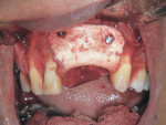 Figure 4 Large osseous defect in the premaxilla
grafted with autogenous bone, allograft, and pre-shaped collagen membrane to
regenerate both vertical and horizontal dimension.