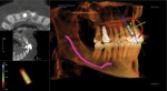 Figure 2 3D imaging to the right shows nerve identification and implant placement in the
maxillary right central incisor area. Right images from top to bottom show, axial view of
implant, cross sectional view, and bone density reading surrounding planned implant.
