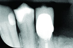Figure 1 Preoperative radiograph of tooth No. 21. The tooth required full coverage because of a lingual cusp fracture and a
large existing mesioocclusal restoration.