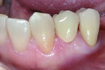 Figure 13 Completed case after cementation with Ceramir® Crown & Bridge Cement.