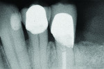 Figure 14 Final radiograph of tooth No. 21 layered zirconia crown.