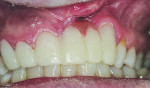 Figure 6 To create a realistic transition between the gingival-color portion of the provisional and the natural gingival tissue, a direct composite technique was used. Combinations of various
pink composite materials were mixed together until a proper shade
was established. The shape and form of the gingiva, including the papilla, was contoured to restore the natural
architecture. After the patient’s approval, an alginate impression model was made of the provisional and sent to the laboratory, along with a customized gingival composite shade tab, to aid in designing the fi nal restoration.