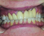 Figure 1 A 45-year-old female patient who had a history of cleft palate surgical correction presented with a six-unit maxillary anterior bridge that had become discolored and had
exposed metal margins. The length of the teeth did not match on both sides when the patient smiled. Her smile line had a “half-moon” shape, and the midline cant was slanted to the left side.