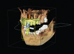 Figure 5 With the aid of CEREC and GALILEOS, the implant was planned using both Sirona 3D cone-beam computed tomography (CBCT) data and optical scan data from the CEREC Omnicam (Sirona Dental, Inc.).