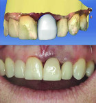 Figure 9 The temporary crown was designed using CEREC software. The gingival embrasures were intentionally left open to facilitate healing.