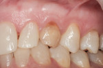 Figure 1 Preoperative view of over-retained tooth No. H, with healthy, broad zone of attached gingiva.