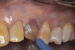 Figure 10 Use of microsurgical straight blade to sever attachment and begin atraumatic extraction of tooth No. H; yellow coloration of teeth was due to povidone/iodine disinfection of operative field.