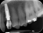 Figure 24 Radiographic view of implant and abutment at 14 weeks, verifying osseointegration; maintenance of crestal bone with some peri-abutment widening was evident.