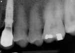 Figure 29 Postcementation view of final crown, radiograph.