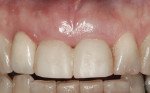 Figure 3 Gingival margin levels shown 2 months after immediate placement and provisionalization.