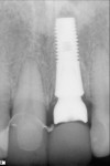 Figure 11 Radiograph of implant placement.