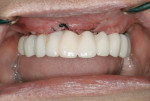 Figure 4 Provisional restoration in place immediately after implant placement.