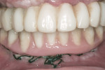 Figure 9 Provisional restoration in place immediately after implant placement.