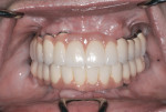 Figure 10 Esthetic result of the prosthesis 2 years after immediate loading.