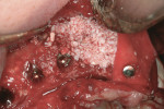 Figure 15 Implant placement with simultaneous bone grafting and membrane immobilization.