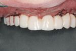 Figure 18 Provisional restoration in place immediately after surgery (implant placement and simultaneous grafting for immediate functional loading).