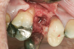 Figure 26 Extraction socket with granulation tissue 2 weeks after tooth extraction.
