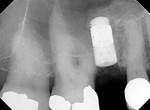 Figure 28 Radiograph immediately after surgery.