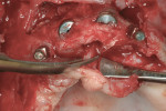Figure 13 Anterior implants before removal, demonstrating the buccal position. The incisal
canal has been prepared before removal of the incisive nerve and implant removal to reconstruct the anterior maxilla.