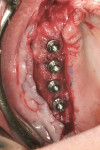 Figure 3 Five months after augmentation, implants were placed and connected with
multibase abutments for fixation of a provisional
screw-retained restoration and immediate
loading.