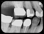 Figure 5 Five radiographs taken with flexible phosphor sensors despite the patient’s severely restricted ability to open his mouth. Right-side bitewing (Fig 4). Left-side bitewing (Fig 5).
Mandibular anteriors (Fig 6). Maxillary anteriors (Fig 7). Maxillary right premolar/molar area (Fig 8).