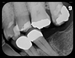 Figure 4 Five radiographs taken with flexible phosphor sensors despite the patient’s severely restricted ability to open his mouth. Right-side bitewing (Fig 4). Left-side bitewing (Fig 5).
Mandibular anteriors (Fig 6). Maxillary anteriors (Fig 7). Maxillary right premolar/molar area (Fig 8).
