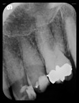 Figure 8 Five radiographs taken with flexible phosphor sensors despite the patient’s severely restricted ability to open his mouth. Right-side bitewing (Fig 4). Left-side bitewing (Fig 5).
Mandibular anteriors (Fig 6). Maxillary anteriors (Fig 7). Maxillary right premolar/molar area (Fig 8).
