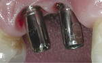 Figure 5 The implant sites with transfer pins in place for a closed-tray impression.
