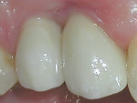 Figure 9 The restorations at 5 weeks showing
continued gingival maturation.