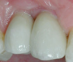Figure 8 The definitive restorations 2 weeks after cementation. Note the significant
soft-tissue development.