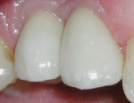 Figure 10 The restorations after 12 weeks
revealing a further refined gingival architecture.