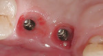 Figure 3 The implant sites after sulcus former removal. Note the soft-tissue position due to bone growth over the shoulders of the implants.