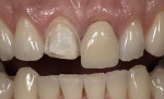 Figure 9  Preoperative and postoperative views of Vita VM9 porcelain and Lava crowns on teeth Nos. 8 and 9. On tooth No. 10 there is a porcelain veneer made with VM9 porcelain in which no tooth preparation was done.
