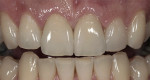 Figure 9  Preoperative and postoperative views of Vita VM9 porcelain and Lava crowns on teeth Nos. 8 and 9. On tooth No. 10 there is a porcelain veneer made with VM9 porcelain in which no tooth preparation was done.
