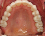 Figure 19. Maxillary arch showing the final
restorations. Note the anatomy on the posterior teeth. The equilibration was completed without flattening the occlusal surfaces but rather enhanced the cusps. Ceramics by Leon
Hermanides, CDT.