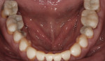 Figure 7. The transitional composite bonding was accomplished using the diagnostic wax-up, and it allowed the occlusion and esthetics to be evaluated before final treatment.