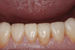 Figure 11. Severely worn lower anterior teeth were restored and showed excellent tissue health.
