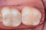 Figure 6 38-month postoperative view of restorations completed with SonicFill.