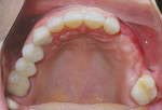 Figure 1  Preoperative occlusal view of theridge after grafting.