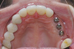 Figure 3  Occlusal view of the healing abutments.