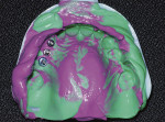 Figure 6  Full-arch impression of the maxillaryarch.