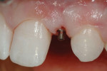Figure 4 Dentatus ANEW implant seated minimally invasive protocol.