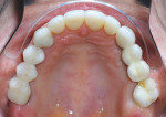 Figure 9  Occlusal view of the crowns seated inthe mouth.