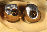 Figure 4. Clinical implant screws are carefully
engineered to ensure proper preload, tension,
and torque levels. The contamination of these
screws will negatively affect their reliability.