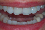 Figure 1. Seated chipped crown.