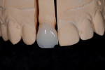 Figure 6. Crown that had incisal chipping.