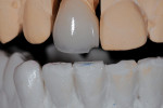 Figure 8. Close-up of incisal edge that could be addressed.