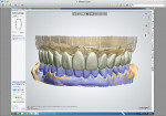 Figure 2. Full-contour digital design using 3Shape software. The blue on the mandibular arch shows the provisional restorations. The upper arch shows the final design.